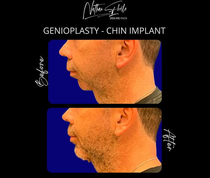 Genioplasty before and after - Actual Patient