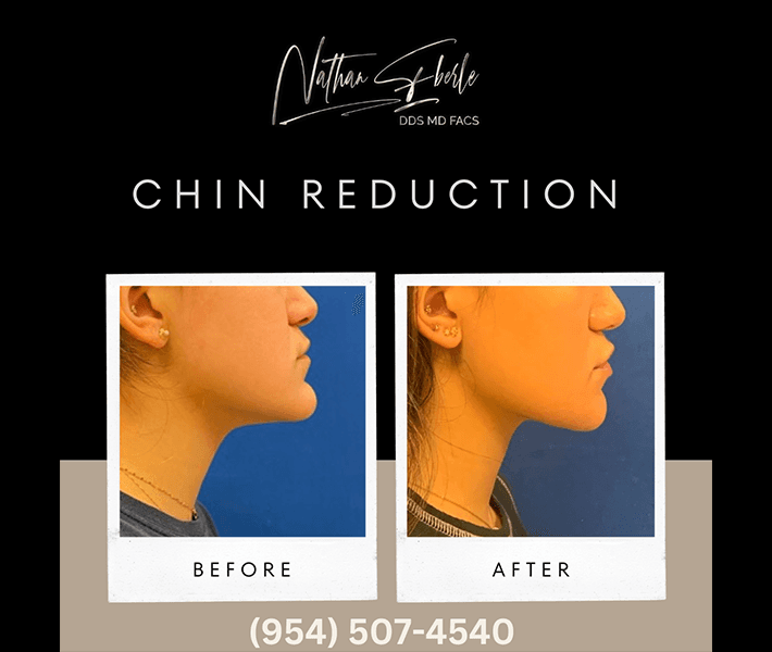 Genioplasty before and after - Actual Patient