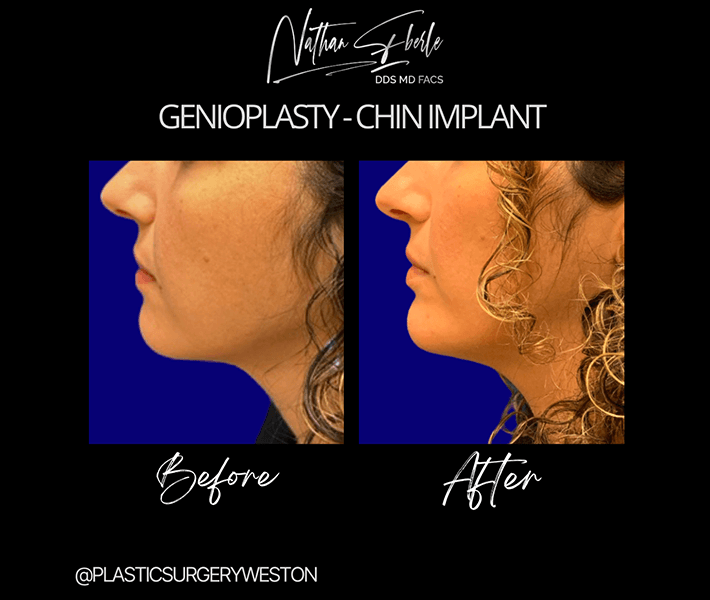 Genioplasty before and after - Actual Patient