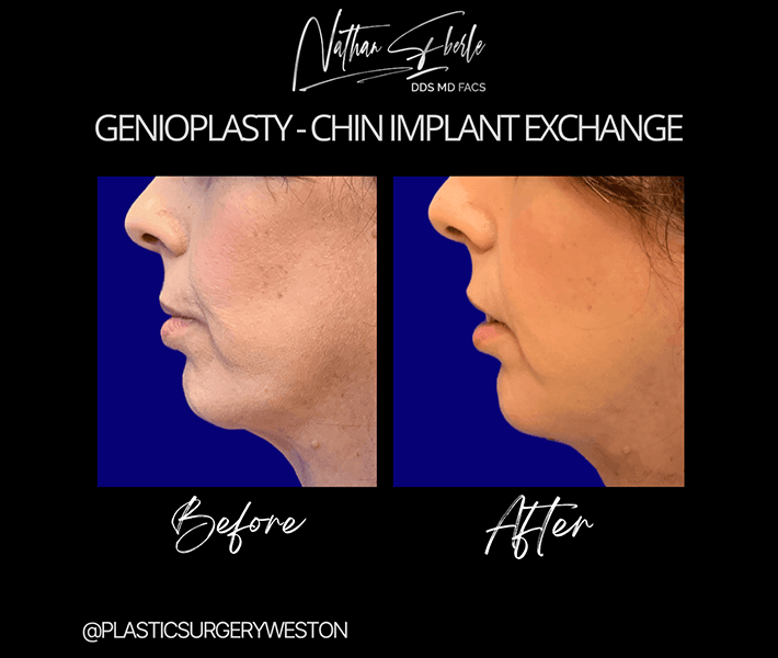 Genioplasty before and after - Actual Patient