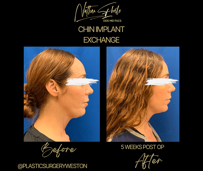 Genioplasty before and after - Actual Patient