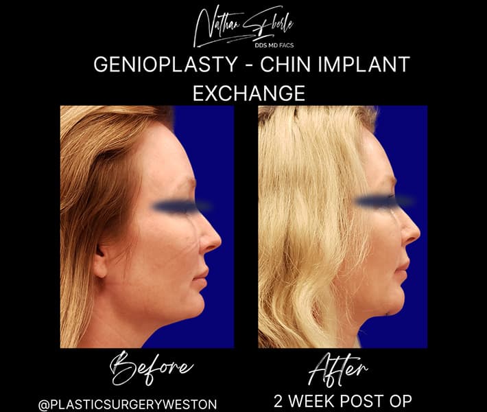 Genioplasty before and after - Actual Patient