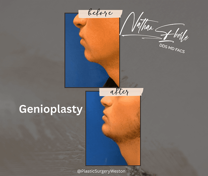 Genioplasty before and after - Actual Patient