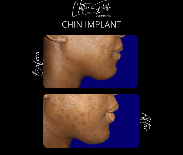 Genioplasty before and after - Actual Patient