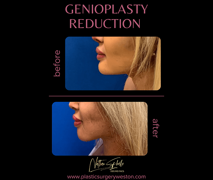 Genioplasty before and after - Actual Patient