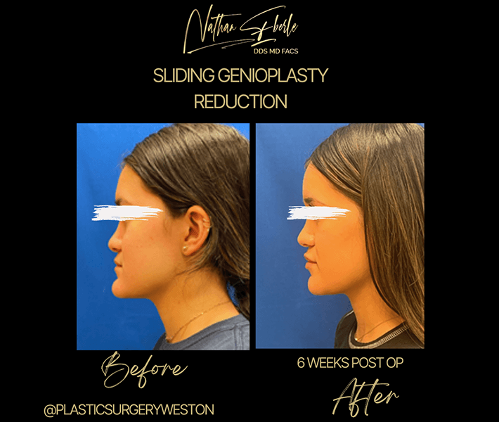Genioplasty before and after - Actual Patient