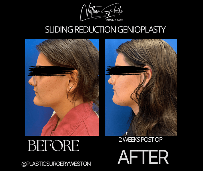 Genioplasty before and after - Actual Patient