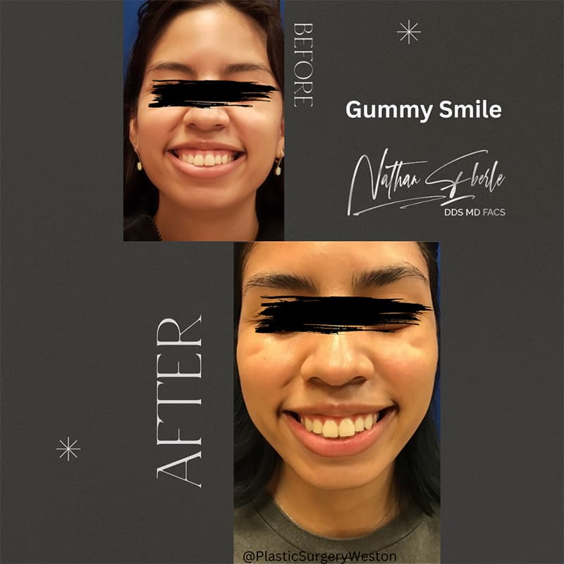 Gummy Smile before and after - Actual Patient