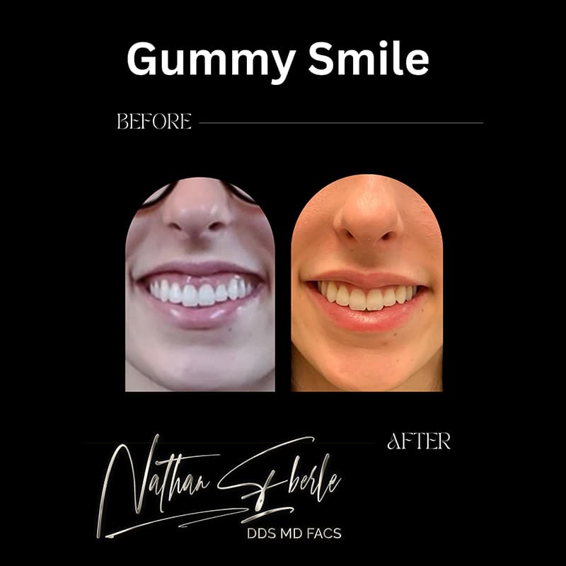 Gummy Smile before and after - Actual Patient