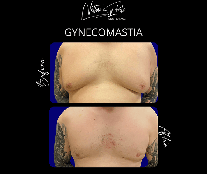 Gynecomastia before and after - Actual Patient