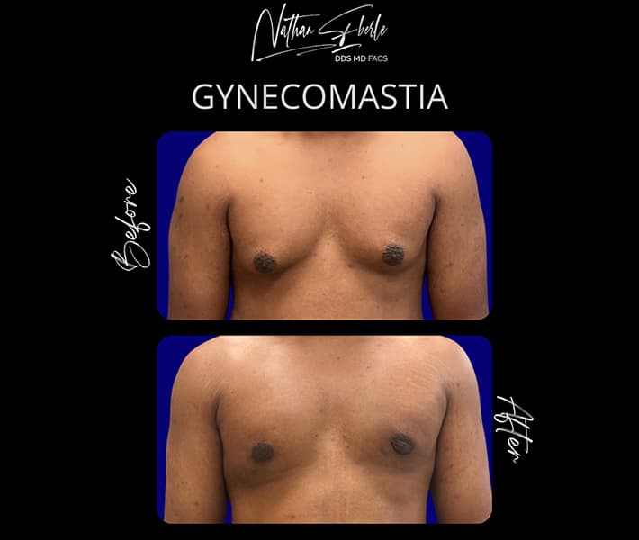 Gynecomastia before and after - Actual Patient