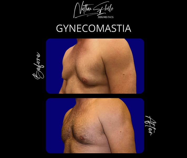 Gynecomastia before and after - Actual Patient