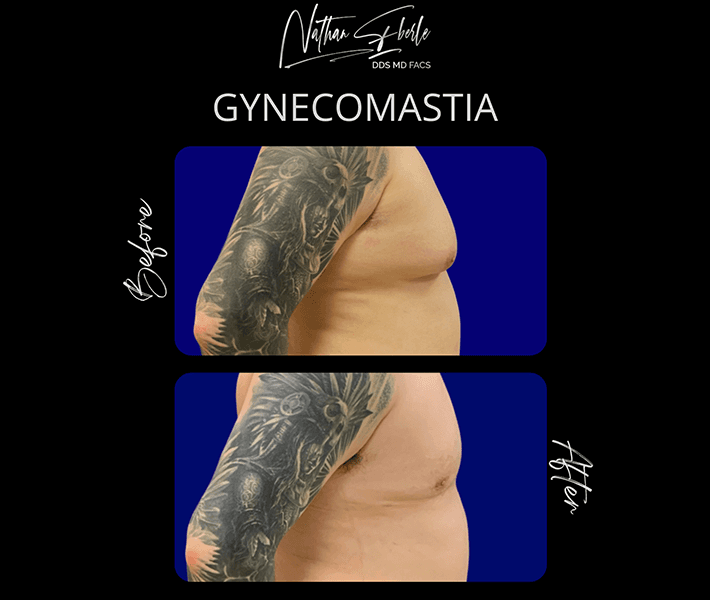 Gynecomastia before and after - Actual Patient