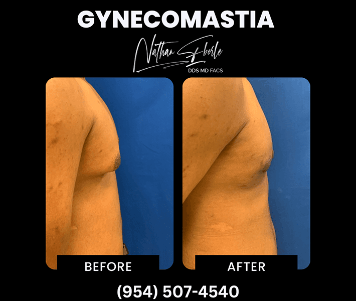 Gynecomastia before and after - Actual Patient