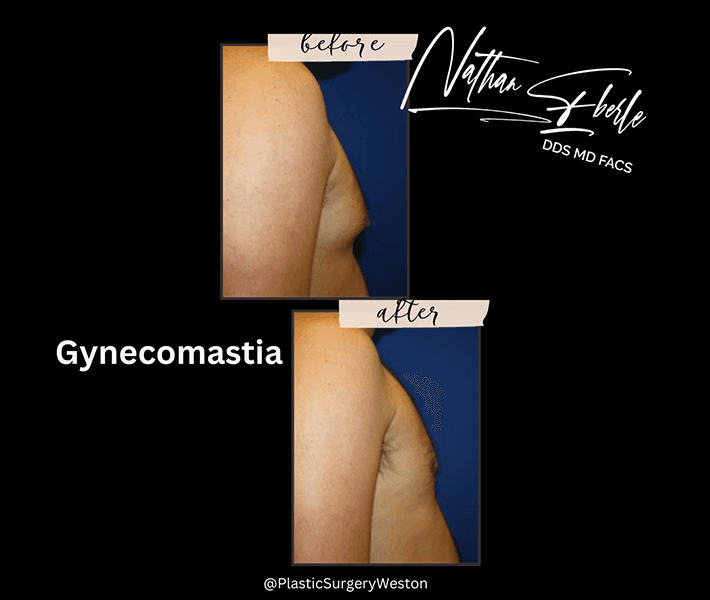 Gynecomastia before and after - Actual Patient