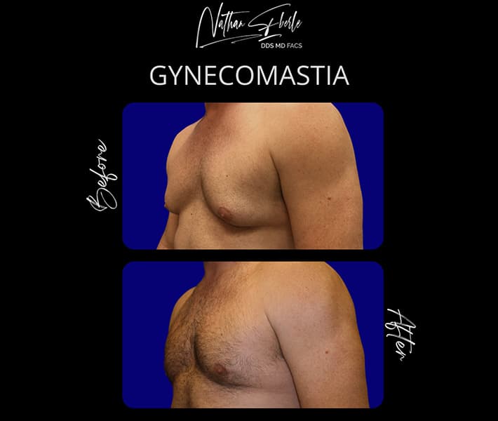 Gynecomastia before and after - Actual Patient
