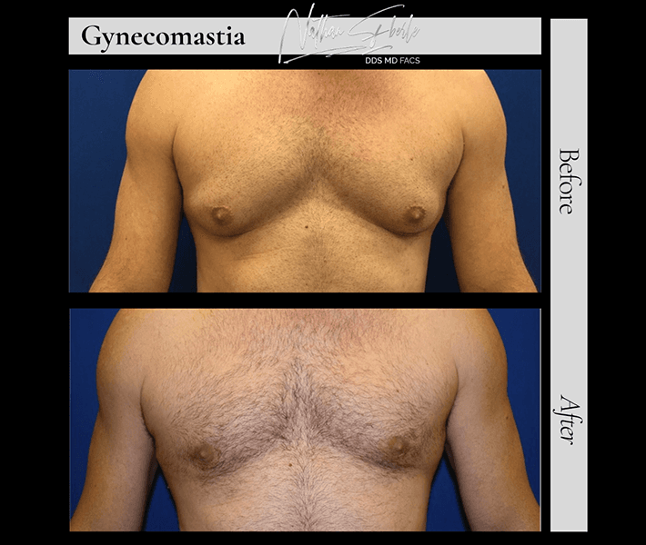 Gynecomastia before and after - Actual Patient
