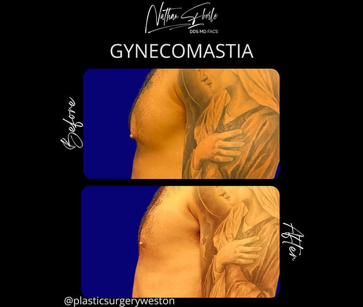 Gynecomastia before and after - Actual Patient