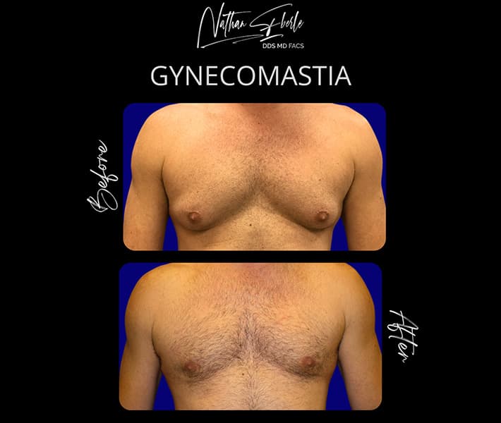 Gynecomastia before and after - Actual Patient