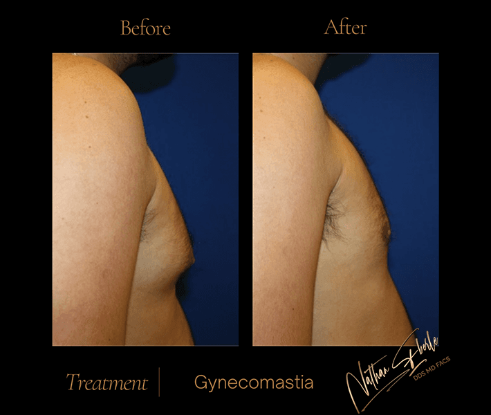 Gynecomastia before and after - Actual Patient