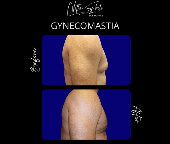 Gynecomastia before and after - Actual Patient