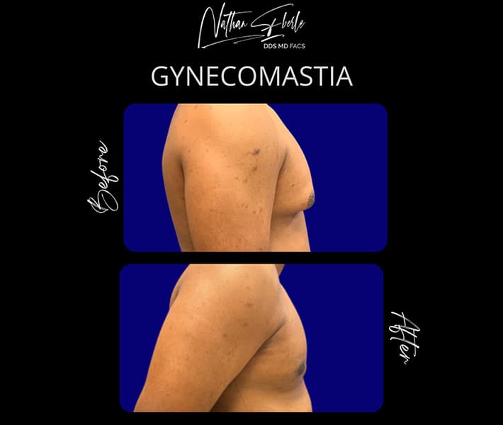 Gynecomastia before and after - Actual Patient
