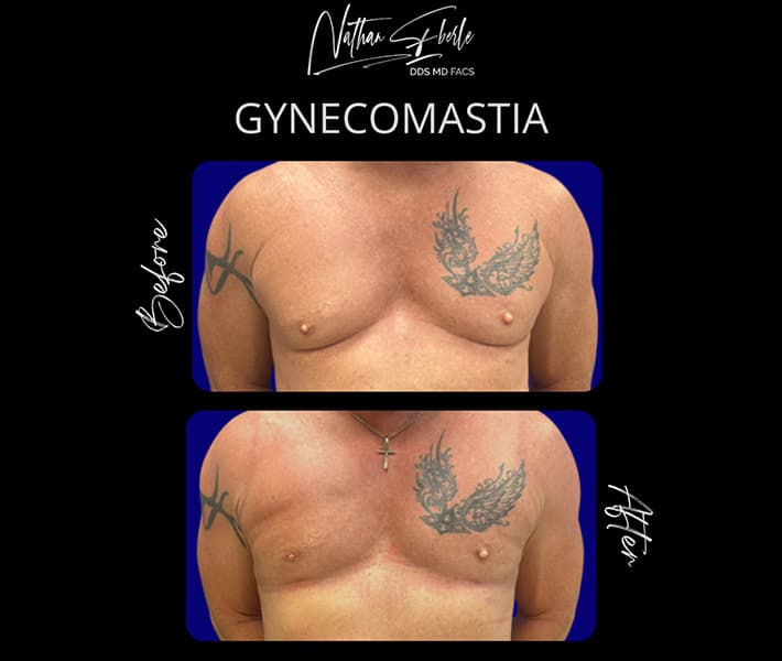 Gynecomastia before and after - Actual Patient