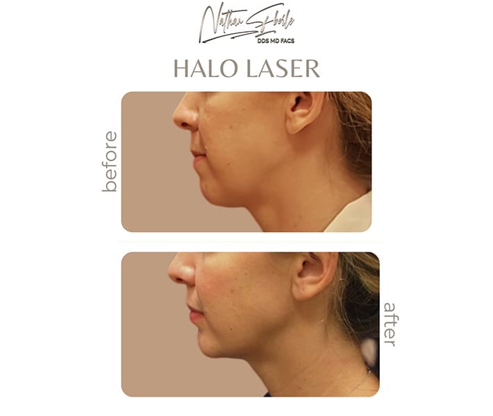 Halo Laser before and after - Actual Patient