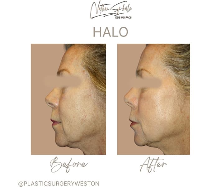Halo Laser before and after - Actual Patient