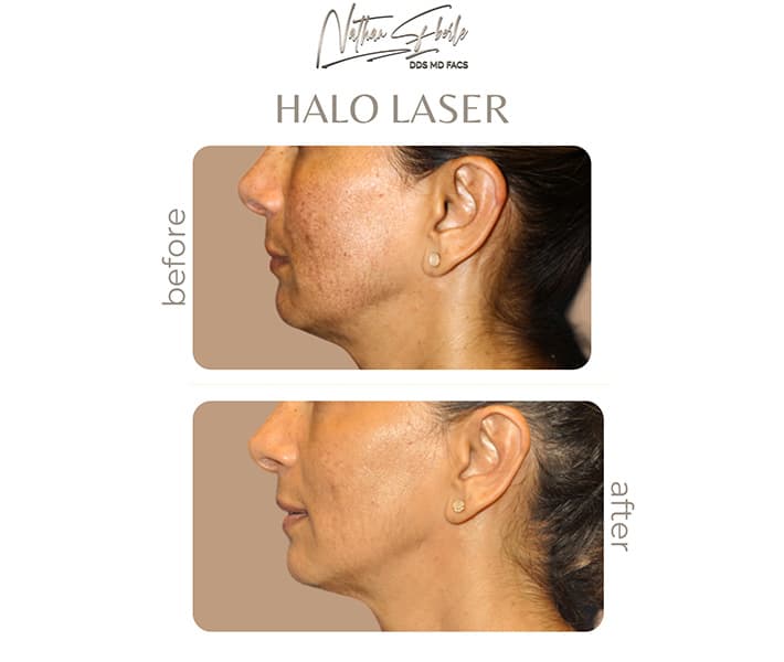 Halo Laser before and after - Actual Patient