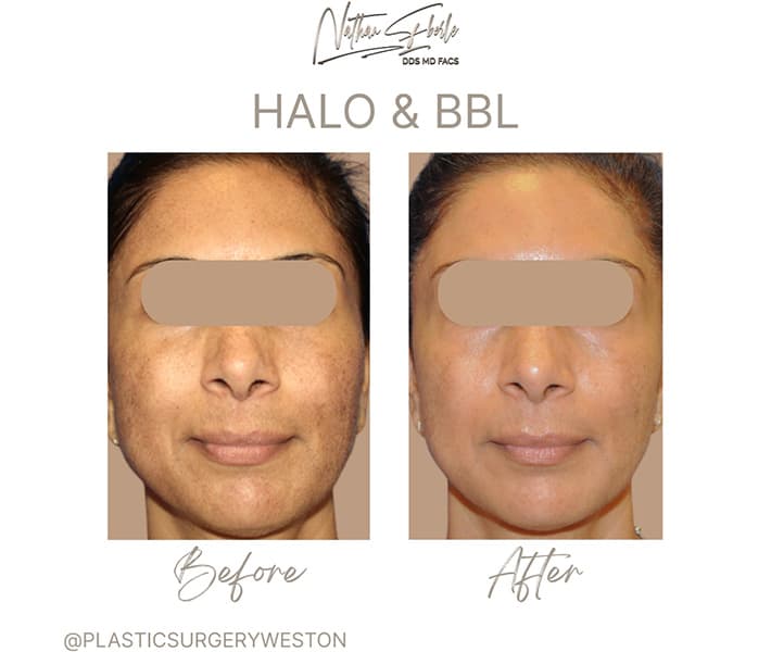 Halo Laser before and after - Actual Patient