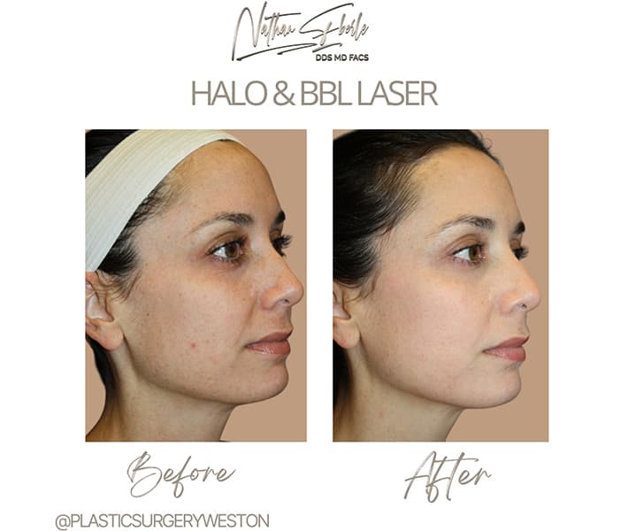 Halo Laser before and after - Actual Patient