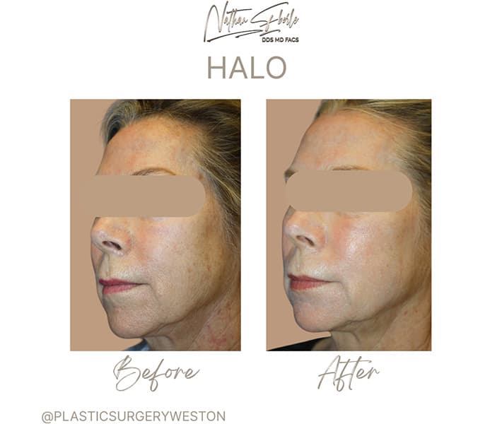 Halo Laser before and after - Actual Patient