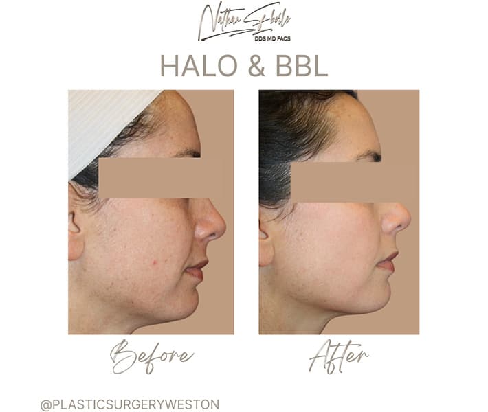 Halo Laser before and after - Actual Patient