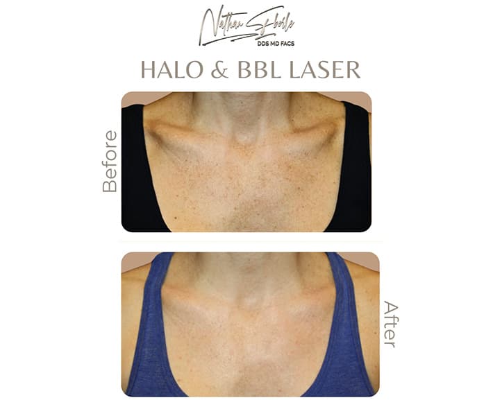 Halo Laser before and after - Actual Patient