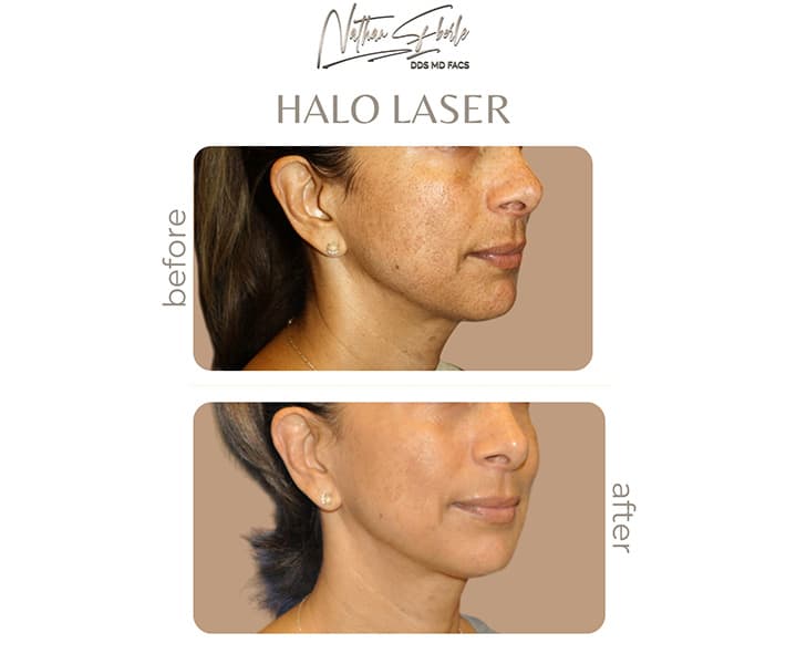 Halo Laser before and after - Actual Patient