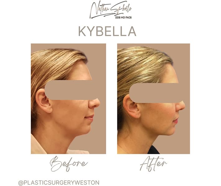 Kybella before and after - Actual Patient