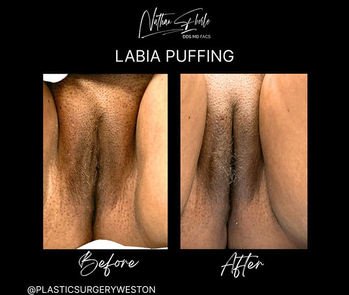 Labia Puffing before and after - Actual Patient