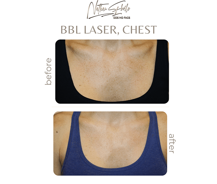 Laser before and after - Actual Patient