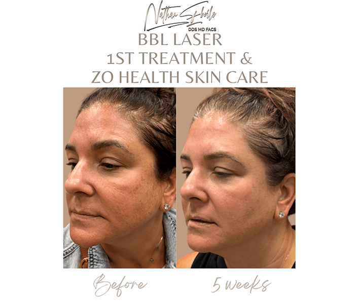 Laser before and after - Actual Patient