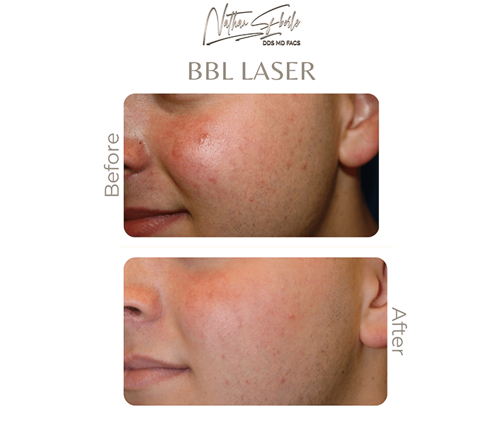 Laser before and after - Actual Patient