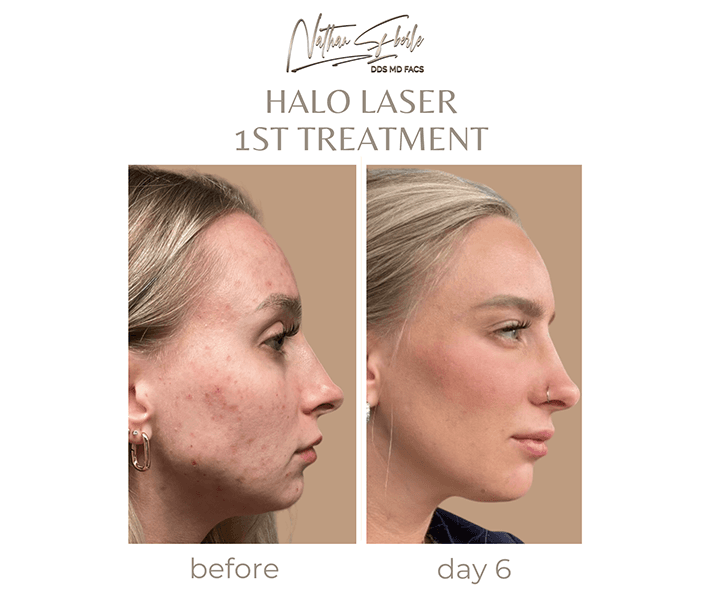 Laser before and after - Actual Patient