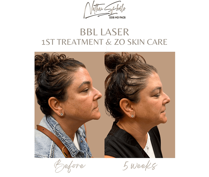 Laser before and after - Actual Patient