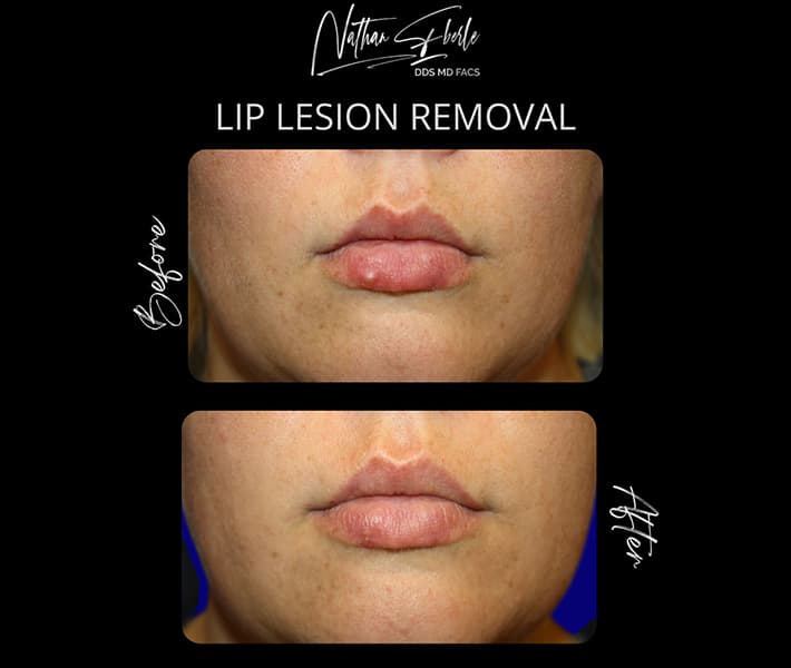 Lip Lesion Removal before and after - Actual Patient
