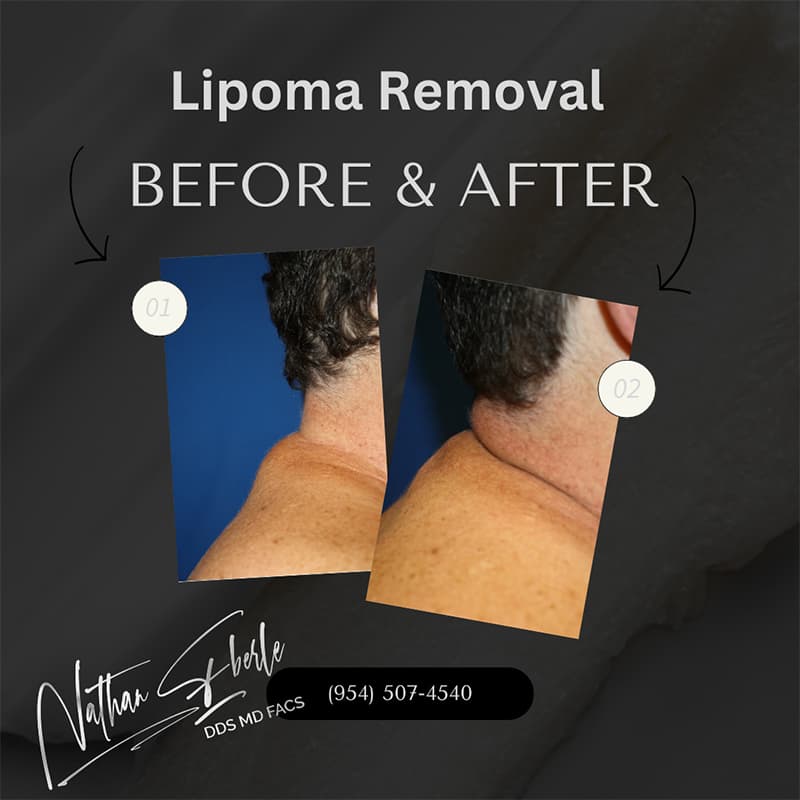 Lipoma Removal before and after - Actual Patient