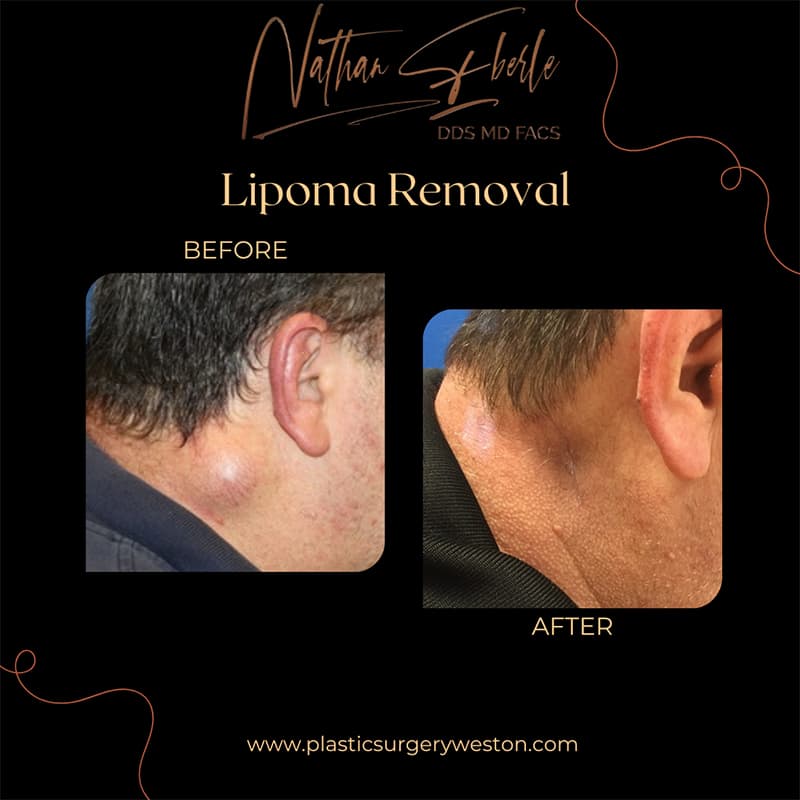Lipoma Removal before and after - Actual Patient