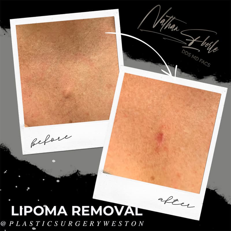 Lipoma Removal before and after - Actual Patient