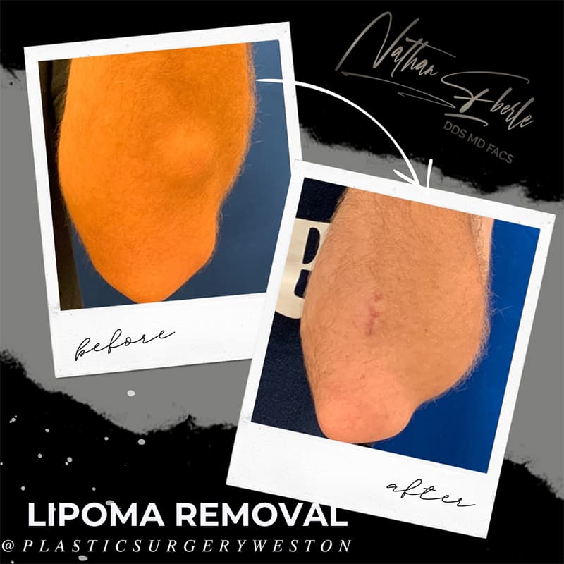 Lipoma Removal before and after - Actual Patient