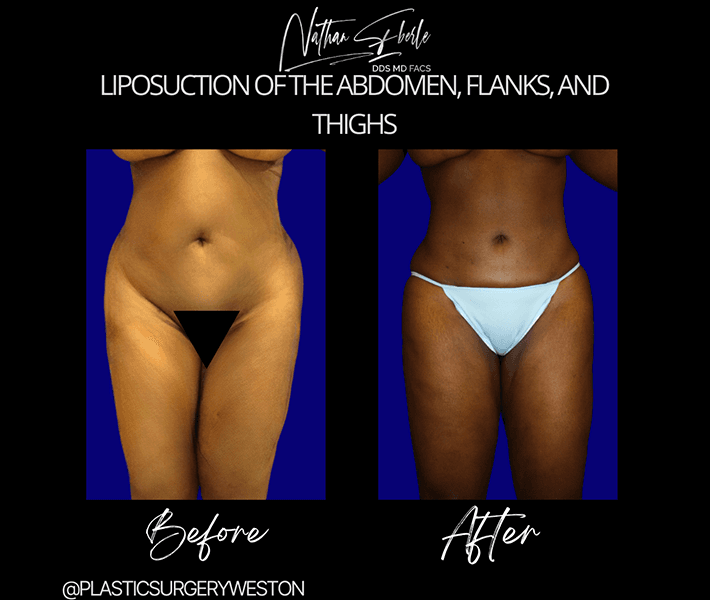 Liposuction before and after - Actual Patient
