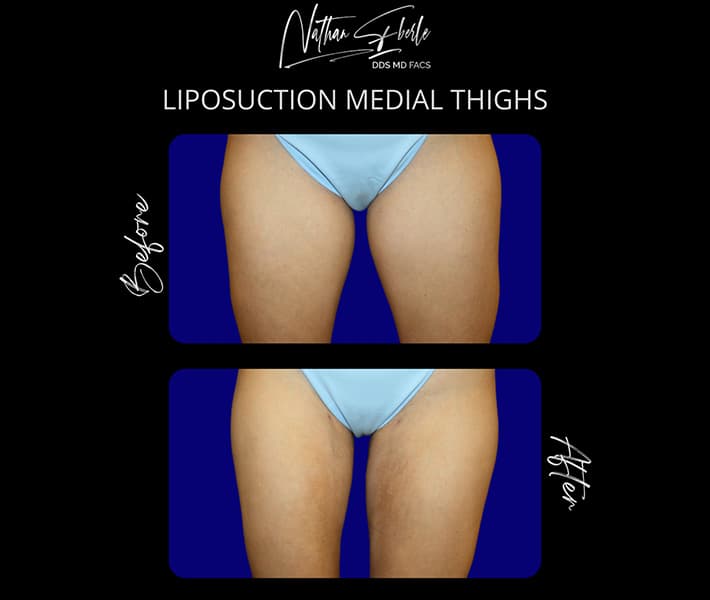 Liposuction before and after - Actual Patient